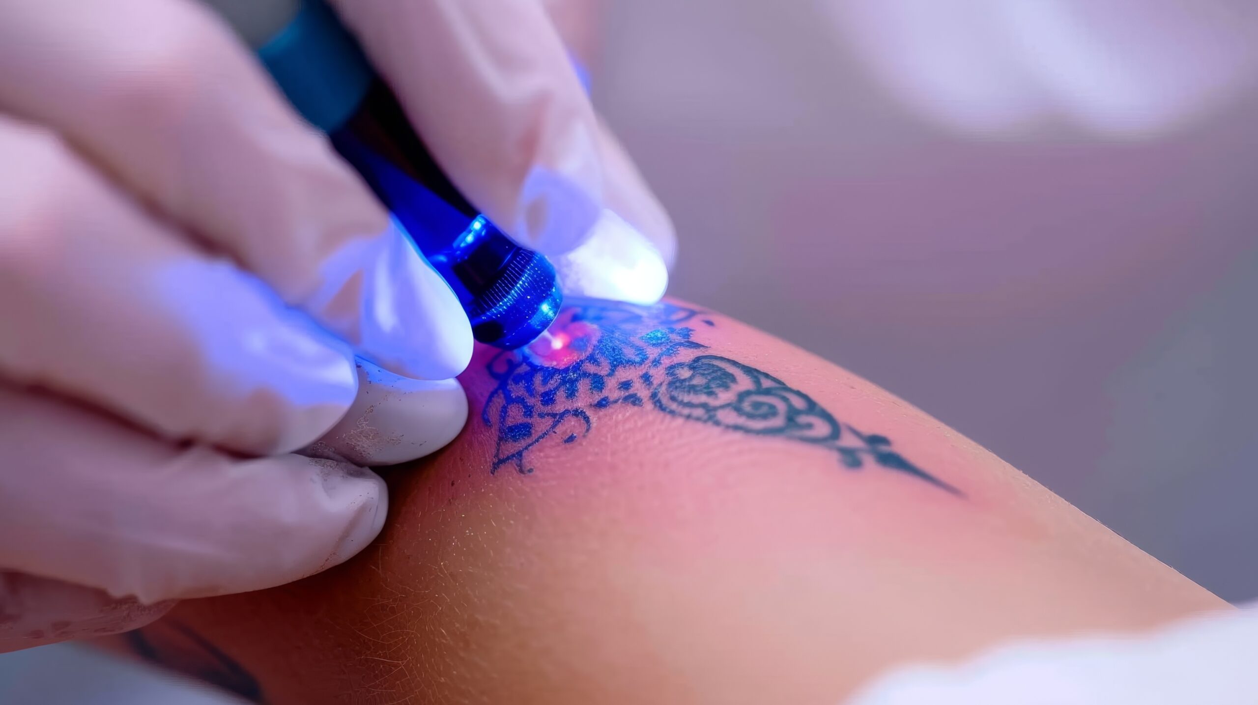 Tattooentfernung Dortmund: Lasergerät